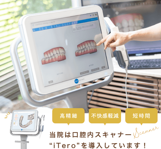 当院は口腔内スキャナーiTeroを導入しています!高精細・不快感軽減・短時間