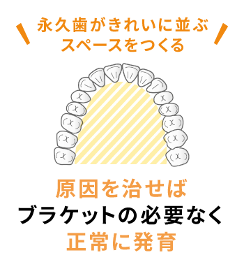 永久歯がきれいに並ぶスペースをつくる 原因を治せばブラケットの必要なく正常に発育
