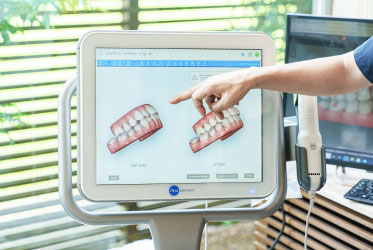 光学スキャナー「iTero」の画面に表示された歯型データ