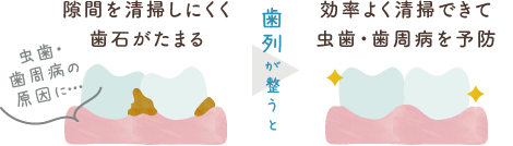 隙間を清掃しにくく歯石がたまり虫歯・歯周病の原因に。歯列が整うと、効率よく清掃できて虫歯・歯周病を予防